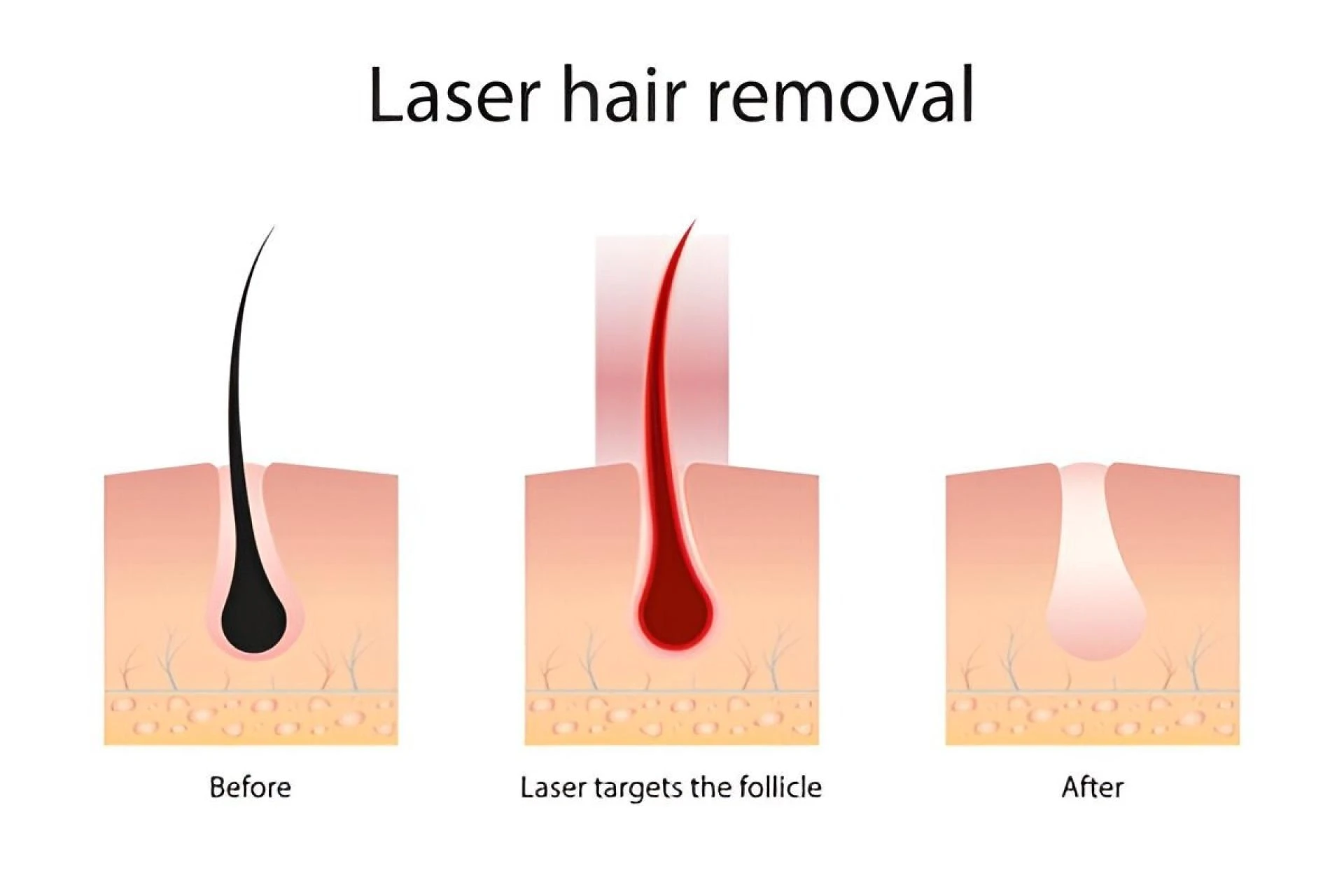 Common Myths About Laser Hair Removal