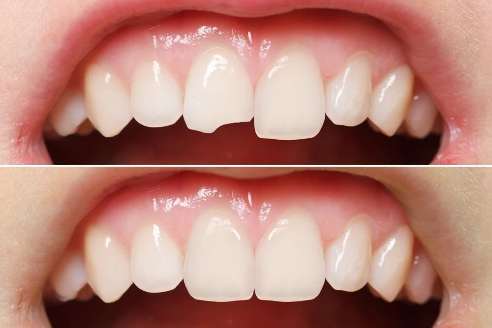 Dental Bonding: A Simple and Effective Way to Enhance Your Smile