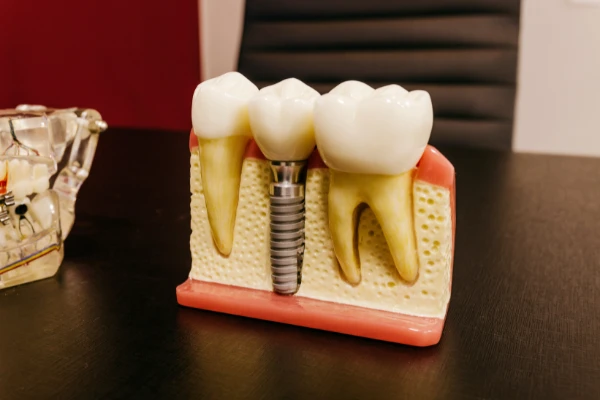 Everything You Need to Know About Teeth Composite Bonding Before Booking !