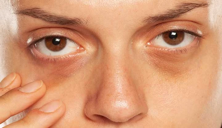 Dark Circles Treatment in Hyderabad: Your Most Common Questions Answered