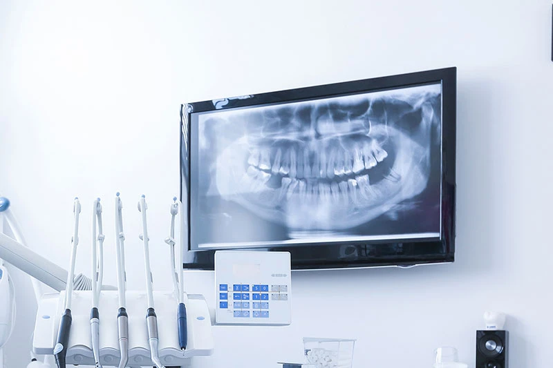 Are Digital X-Rays Safe for Kids? What Parents Need to Know !