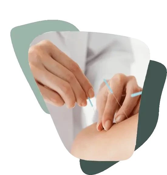 Acupuncture: How It Can Help with Burnout Issues