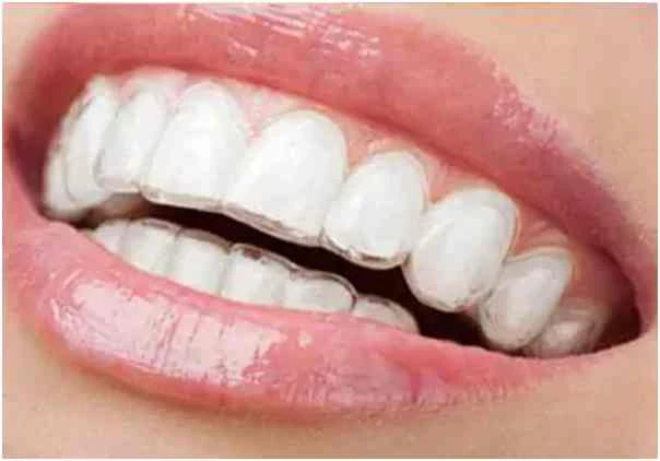 How To Balance Work And Social Life With Clear Aligners