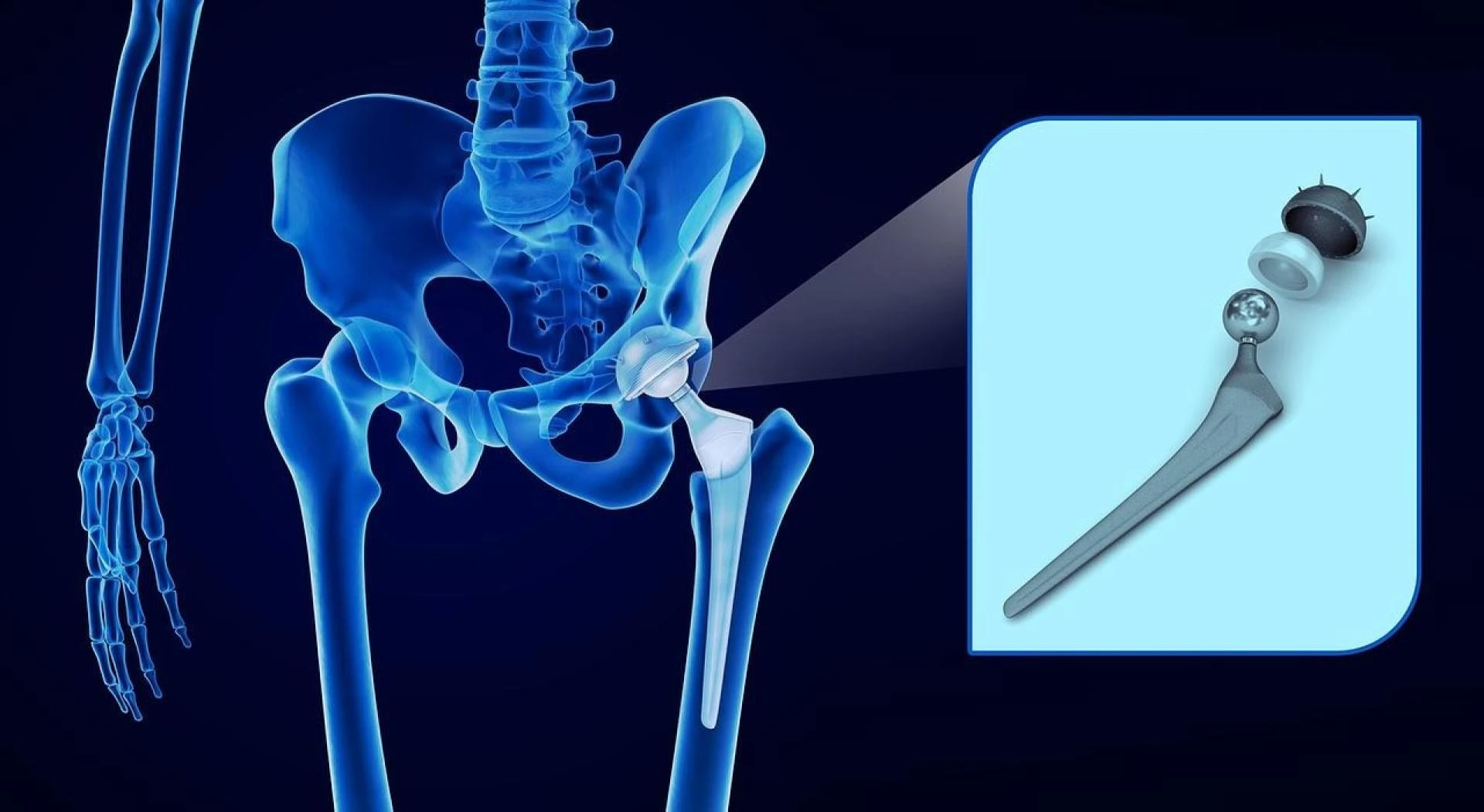 Transforming Lives Through Modern Total Hip Replacement Surgery in Delhi