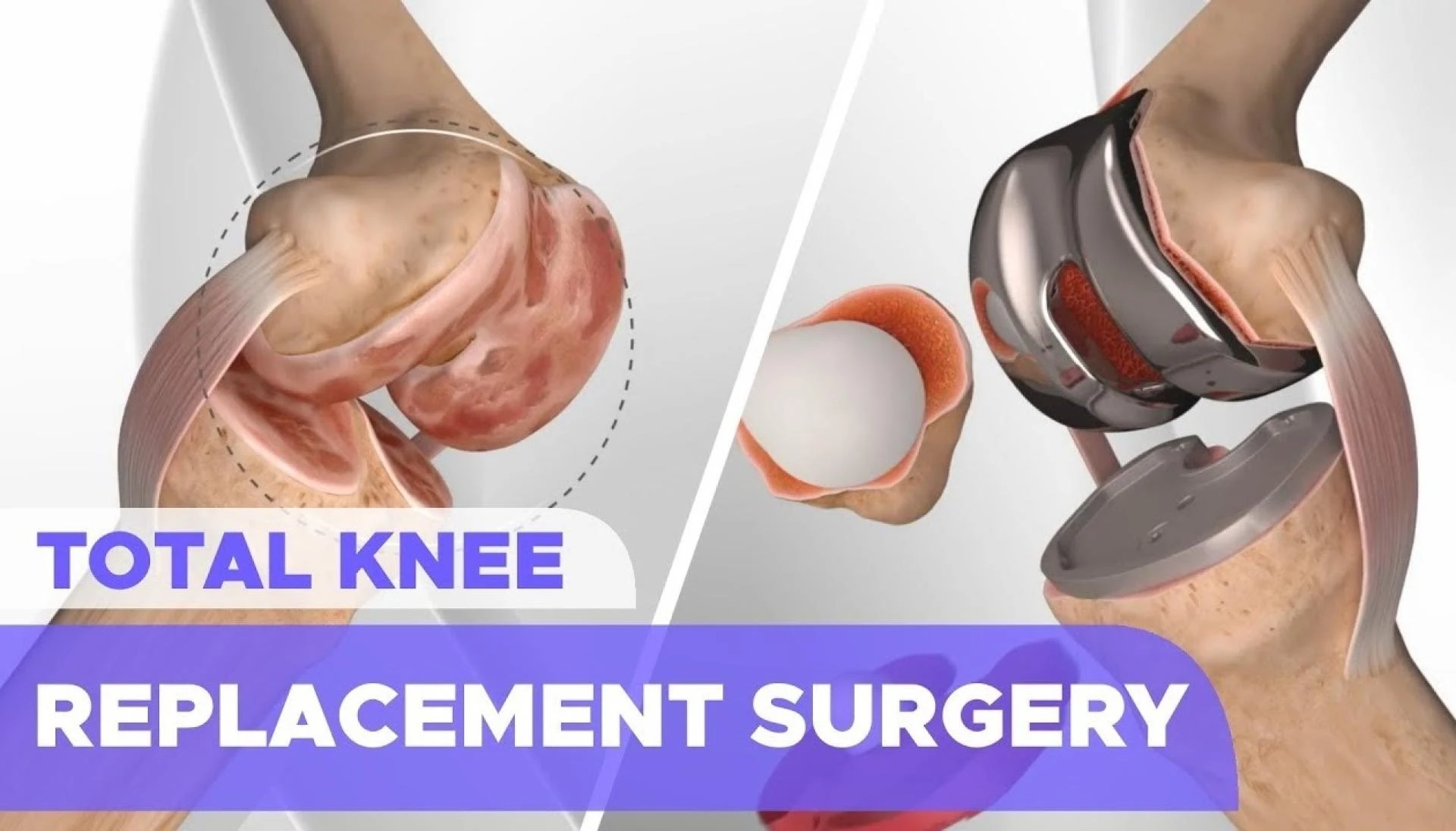 Experience Precision and Comfort with Total Knee Replacement Surgery in Delhi