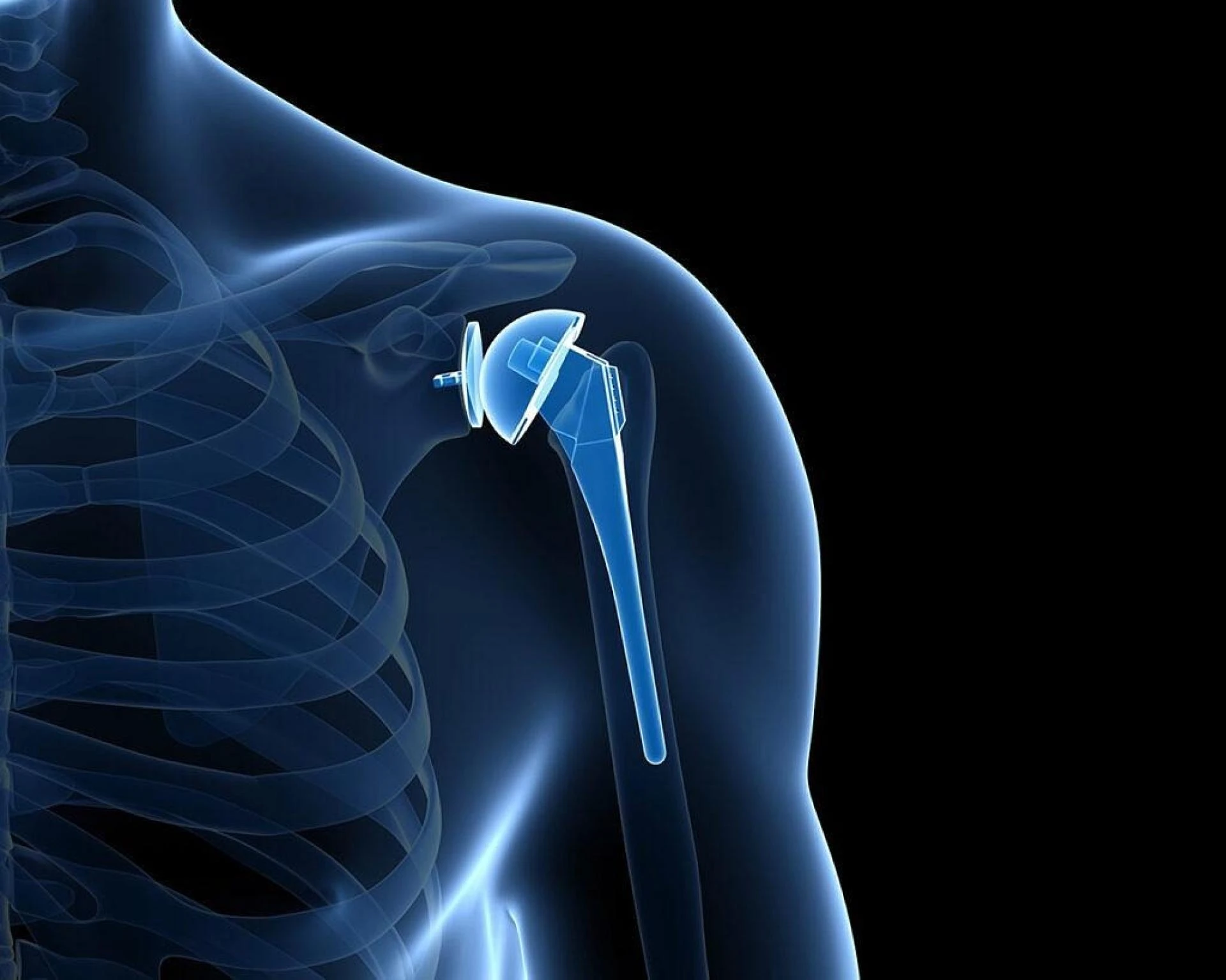 Expert Care for Shoulder Arthritis and Injuries: Total Shoulder Replacement Surgery in Delhi