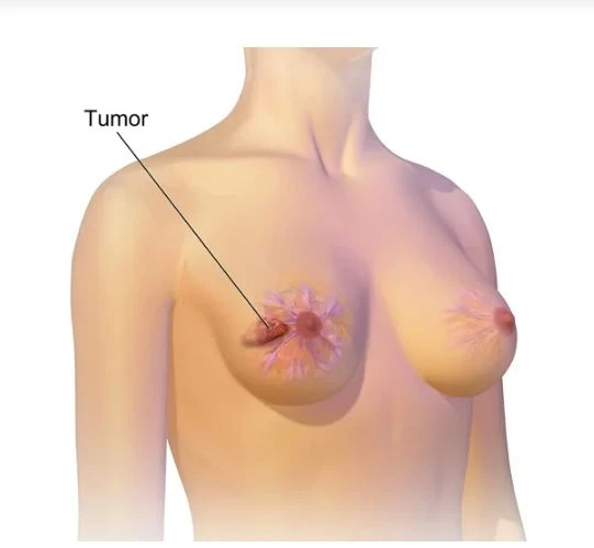 Breast Cancer Doctor in Kolkata – Choosing the Right Specialist for a Confident Recovery