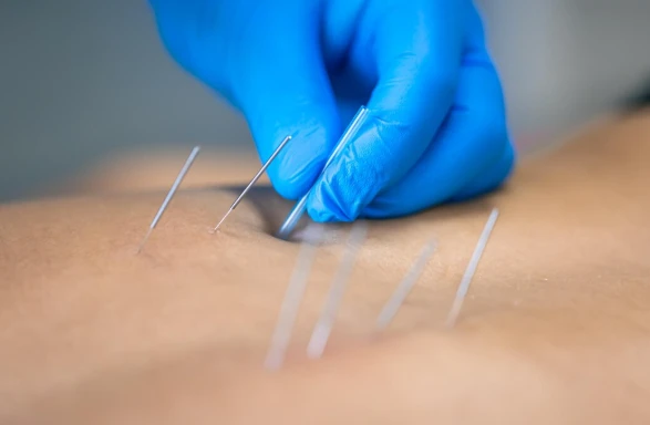 Acupuncture in Augusta: A Natural Approach to Health and Wellness