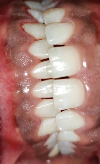 Teeth Cleaning in Bhopal Benefits Professional Scaling for Oral Health