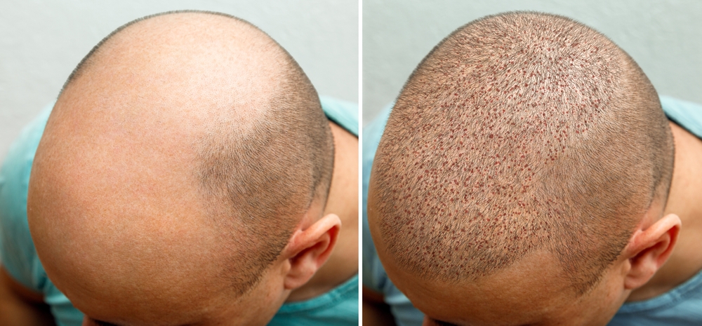 Hair Transplant Near Me – Advanced, Permanent & Affordable Hair Restoration Solutions
