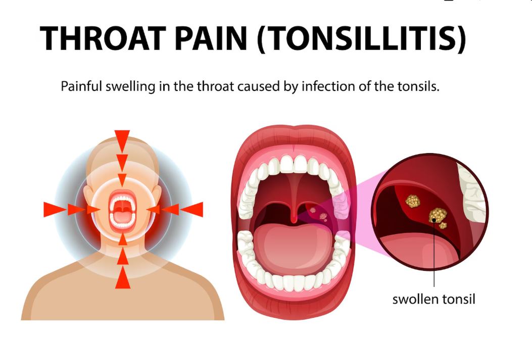 Tonsillitis in Children and Adults: A Practical Guide to Symptoms and ENT Treatment