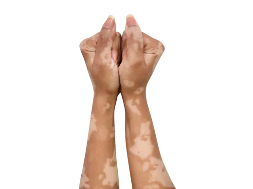 Revitalizing Confidence: A Complete Guide to Vitiligo Treatment in Bandra