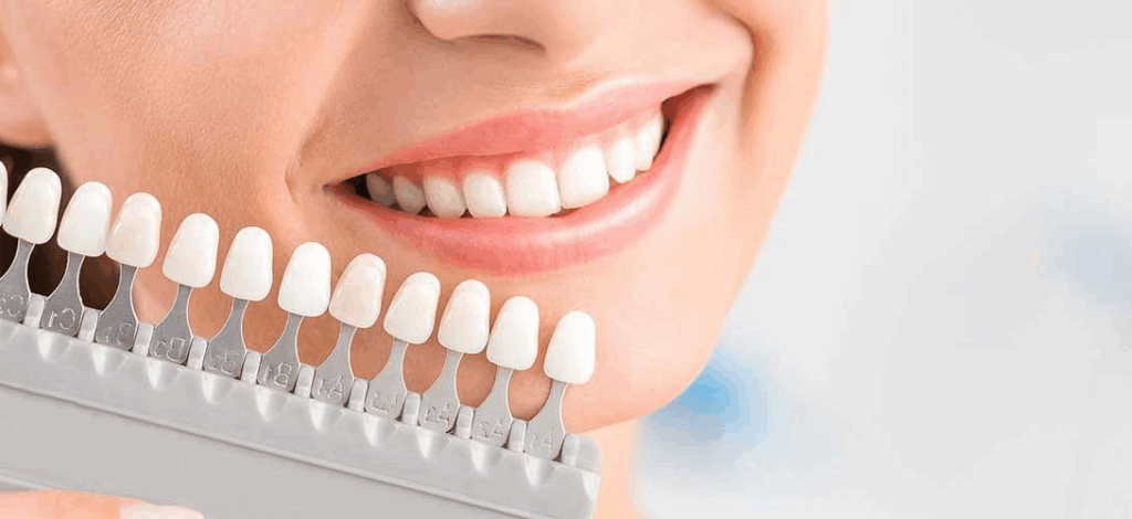 What Are Dental Veneers Procedure?