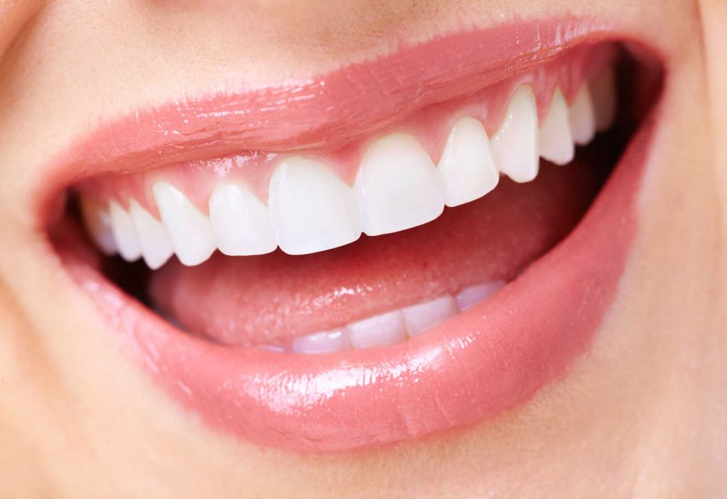 What Are Dental Veneers Procedure?