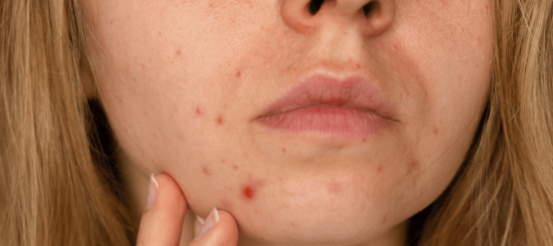 Boil vs. Pimple: Know the difference Between a Boil and Pimple - The Pink Foundry