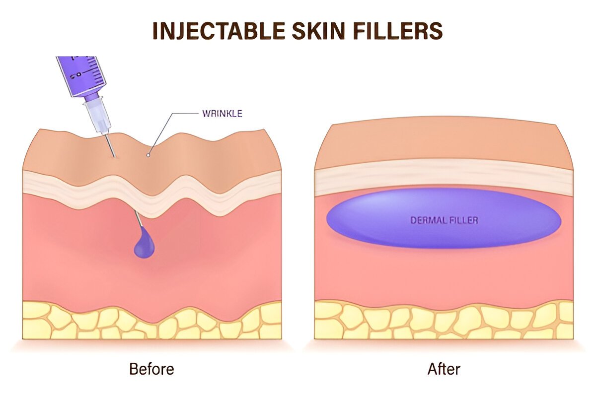 A Beginner’s Guide to Dermal Fillers: Everything You Need to Know