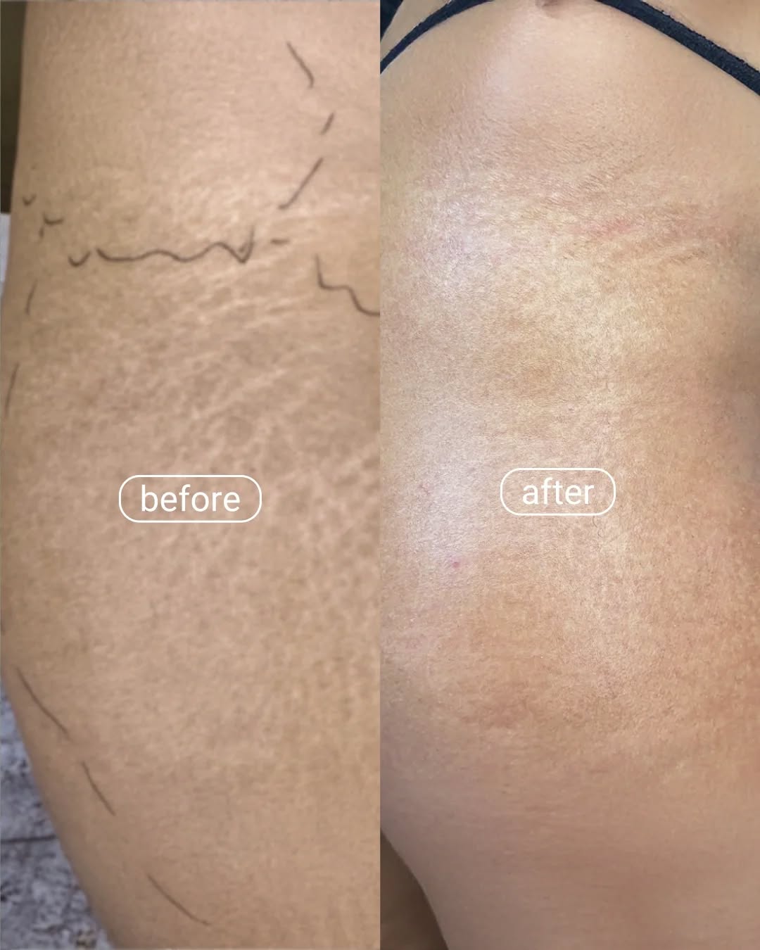 How Does Stretch Marks Removal Treatment Work?