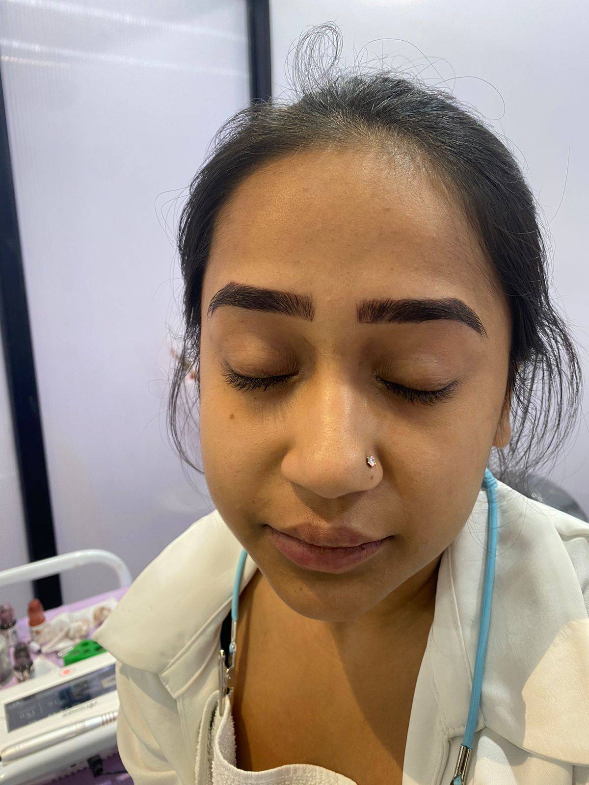 Botox Treatment in Delhi: Smooth Wrinkles Without Losing Natural Expressions