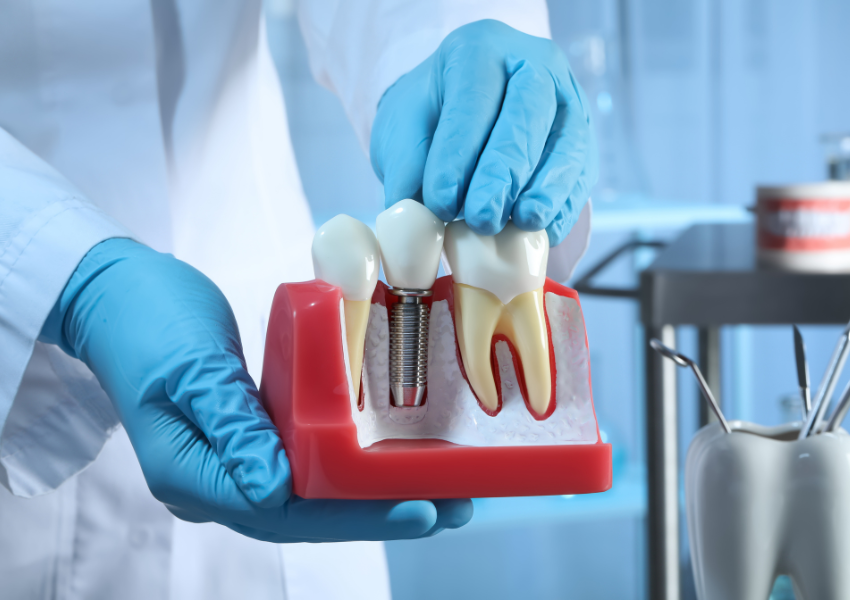 What Are Denture Implants?