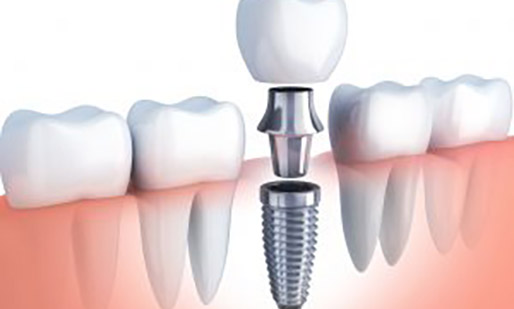 What Are Dental Implants? A Complete Guide to Permanent Tooth Replacement