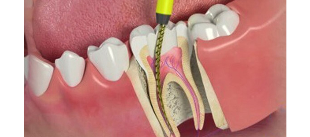 Root Canal Treatment Dubai – Comprehensive Guide with Dental Home