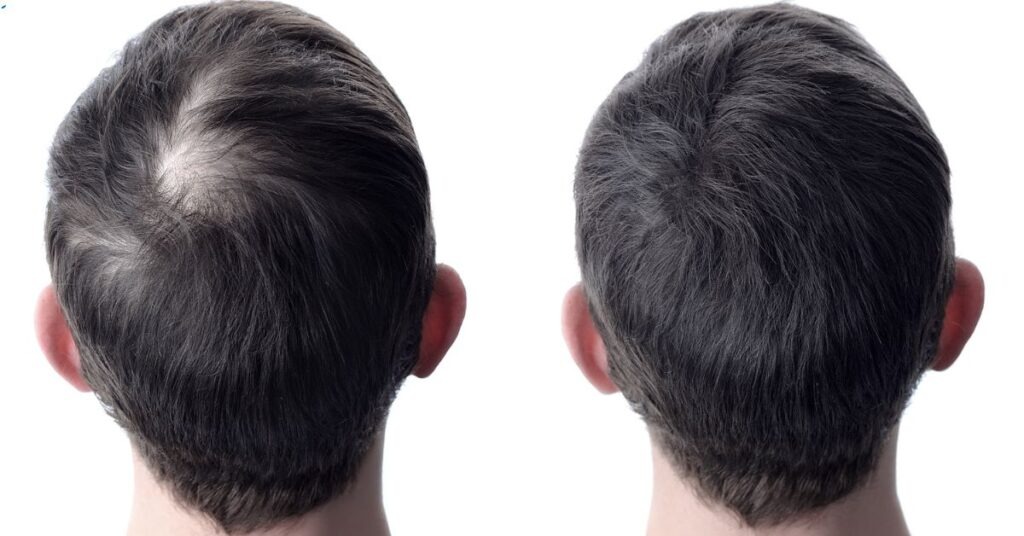 Hair Restoration From Carboxytherapy to Surgical Hair Transplants ()
