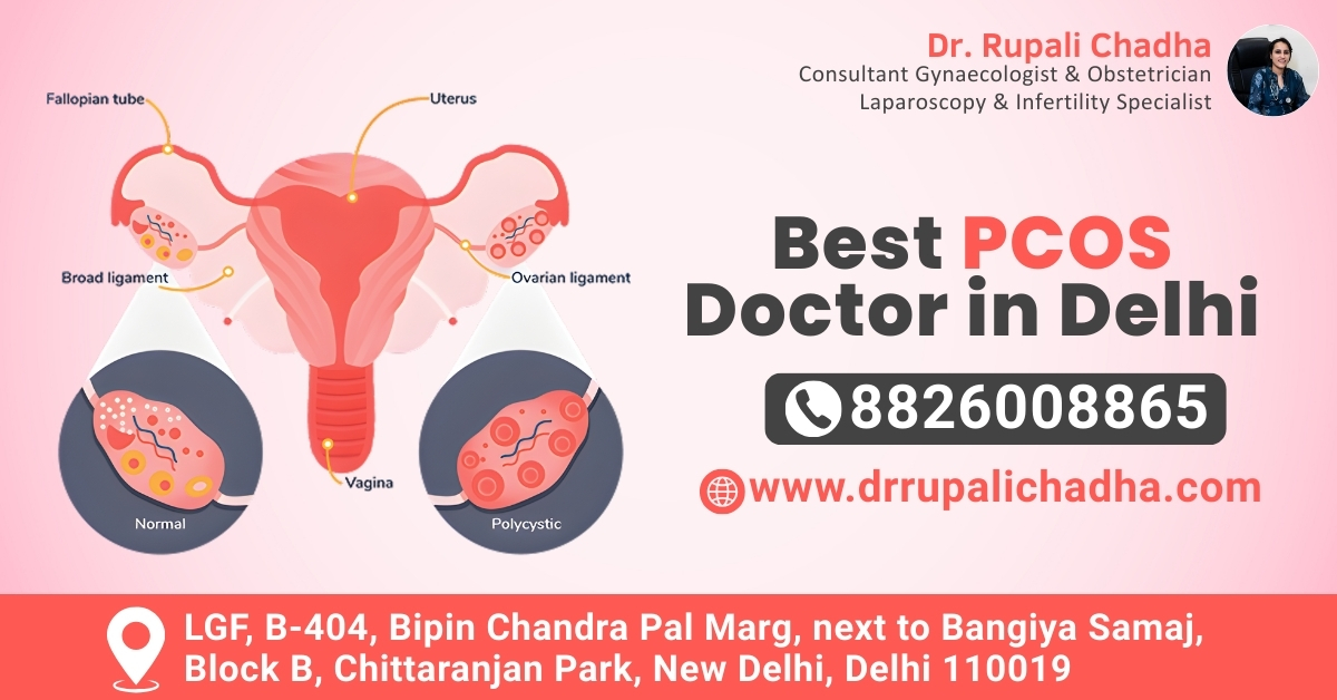 Dr. Rupali Chadha: Best PCOS Doctor in Delhi