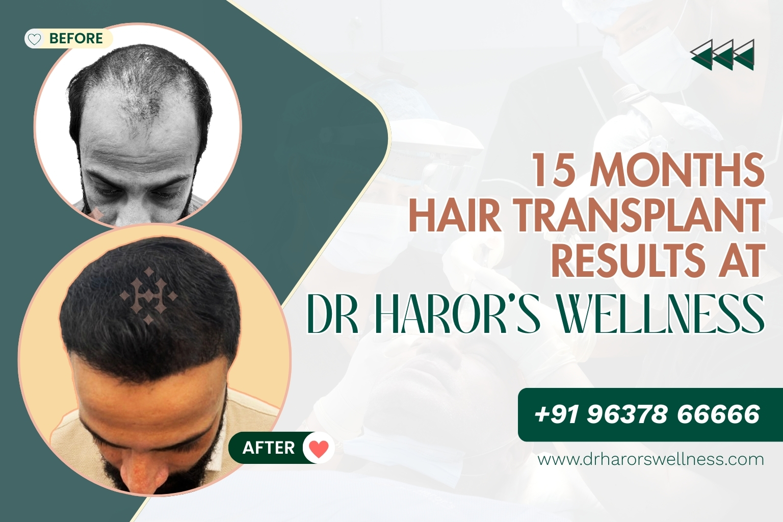15 Months Hair Transplant Results at Dr Haror’s Wellness