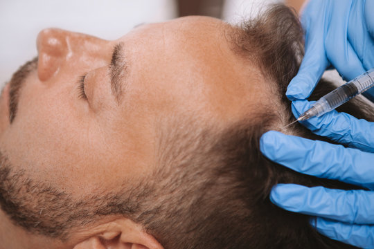 Most Effective Solutions for Male Hair Loss Today