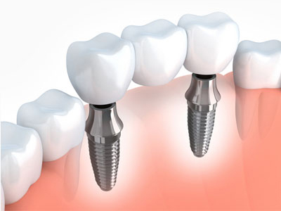 Why Patients Choose Dentures Implants for Full Mouth Restoration?