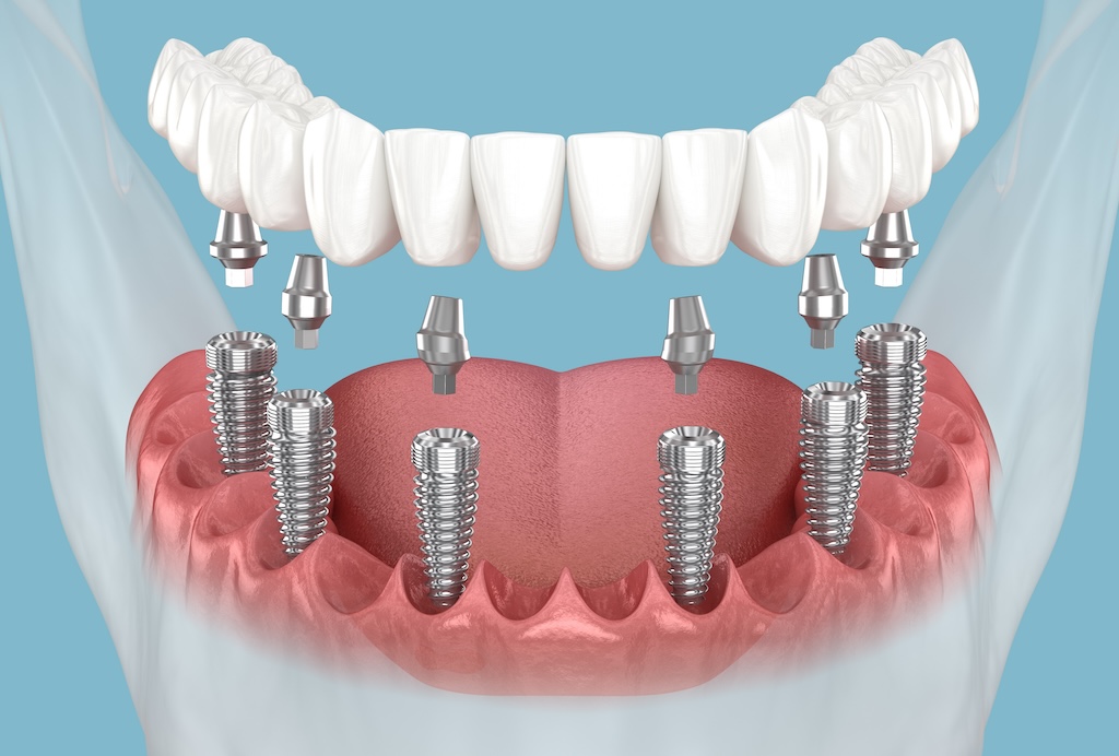 Why Patients Choose Dentures Implants for Full Mouth Restoration?