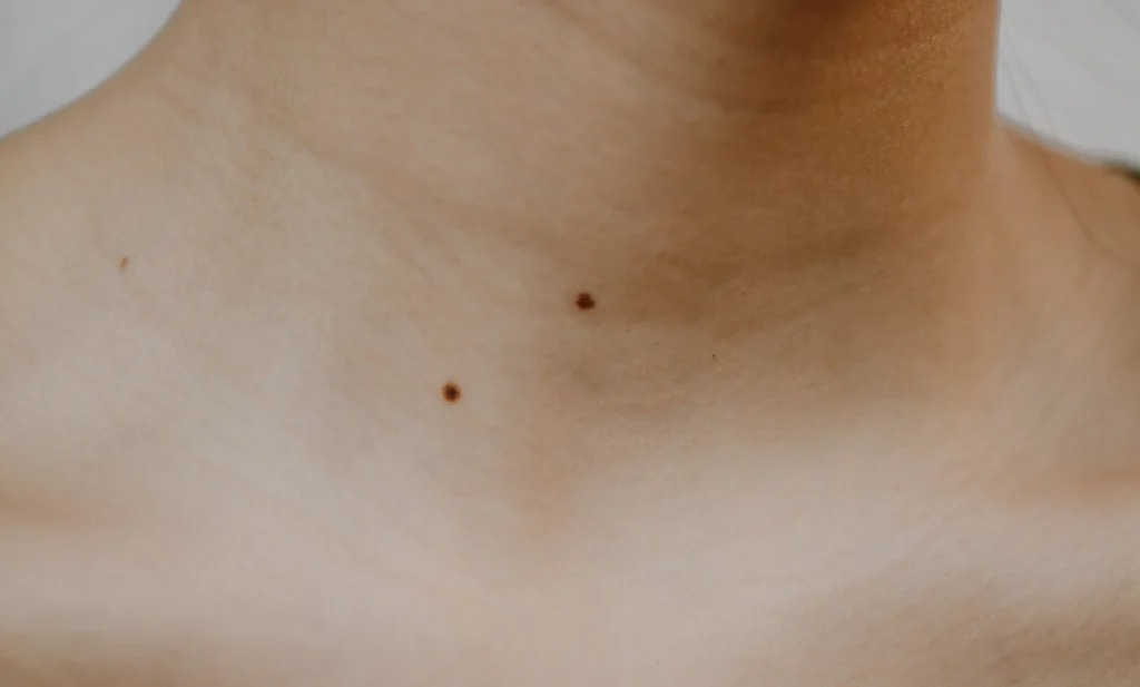 What Causes Skin Tags on the Neck and How to Treat Them Safely