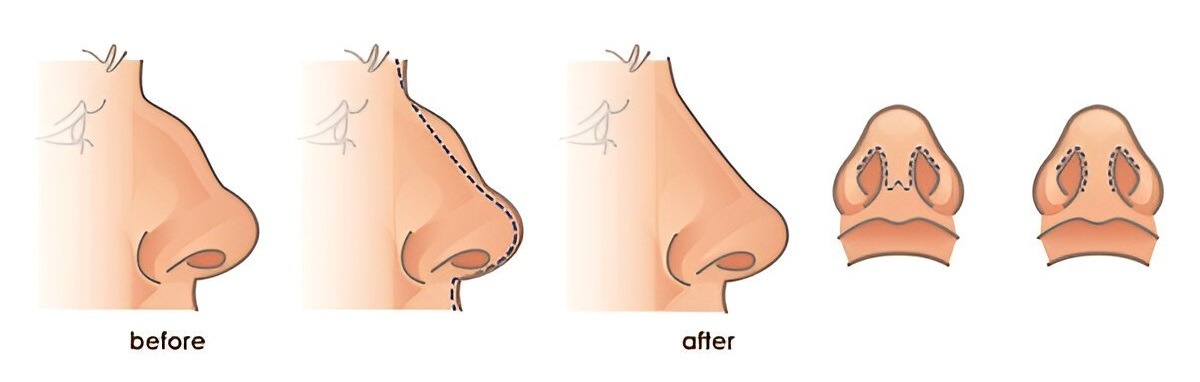 Harmony Over Perfection: The New Era of Rhinoplasty