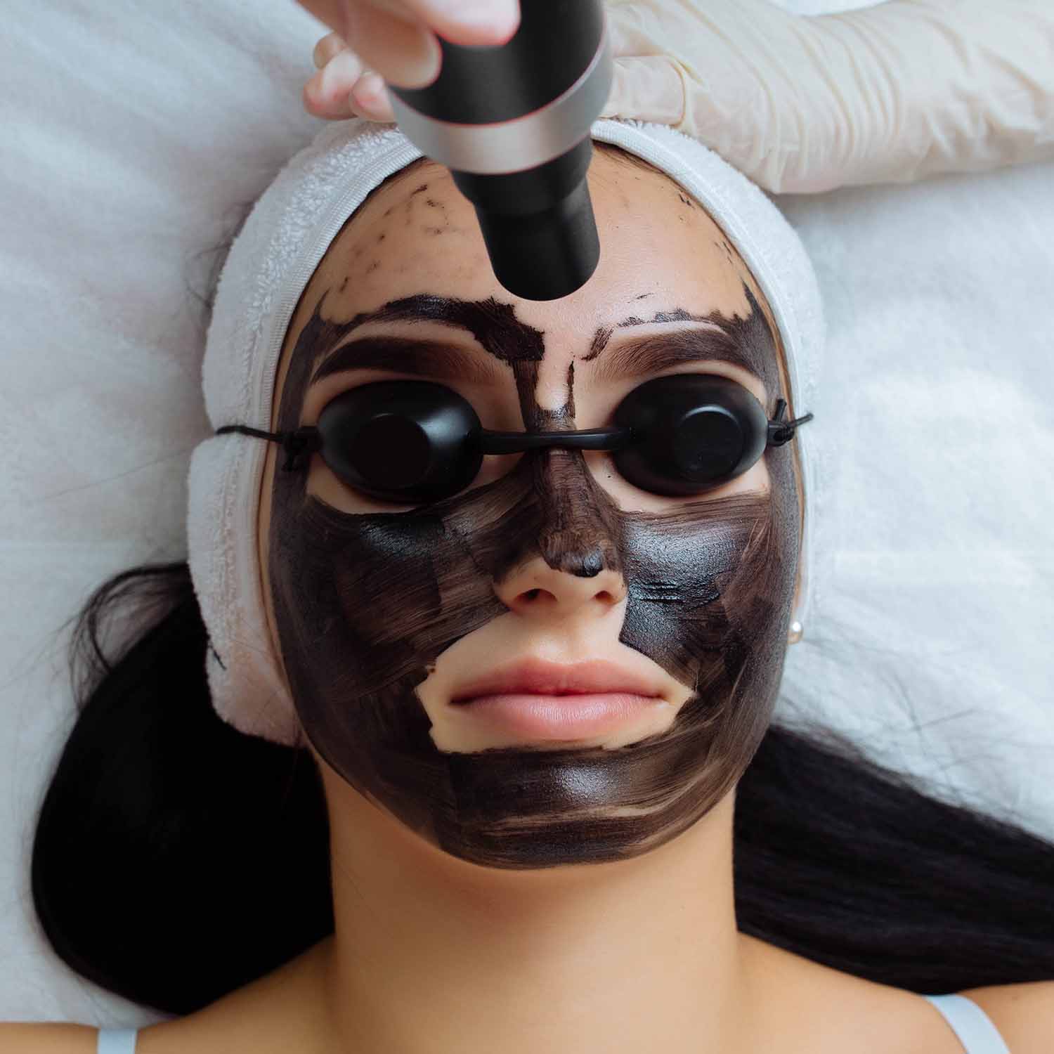 Carbon Laser Peel Treatment: The Secret to Clear, Radiant, Youthful Skin