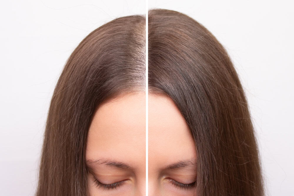 Biocell Treatment for Hair Growth: A Breakthrough Cell Therapy for Hair Loss