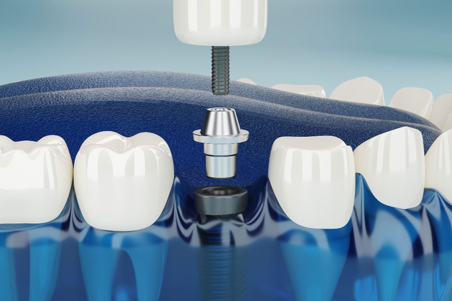 Dentures Implants Recovery: What to Expect After Implant Replacement ?