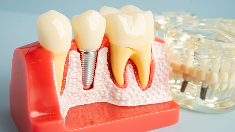 Dental implants graphic representation