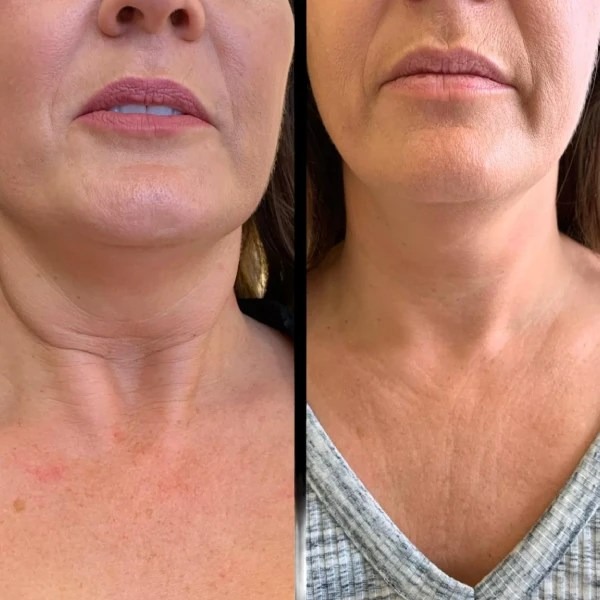 Give Your Skin a New Beginning with Profhilo in Dubai