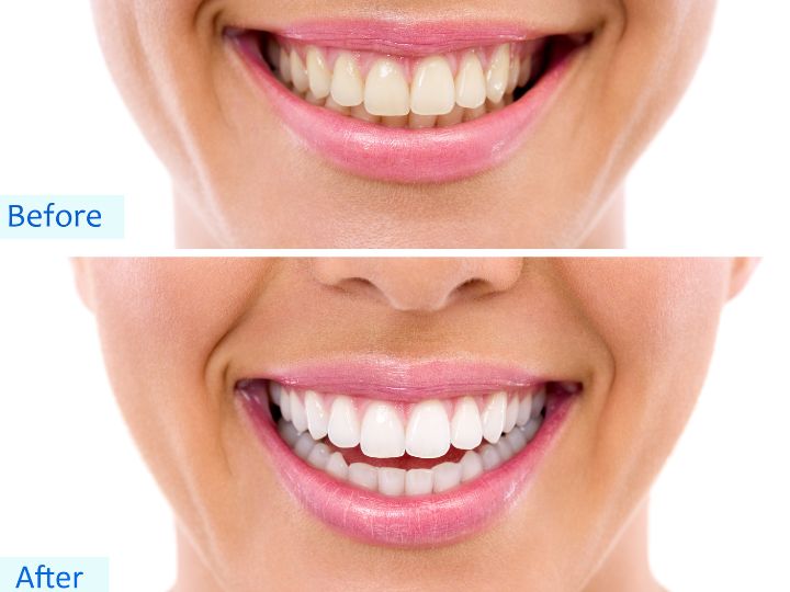 How Often Will You Need Touch-Ups After Paying Teeth Whitening Price?