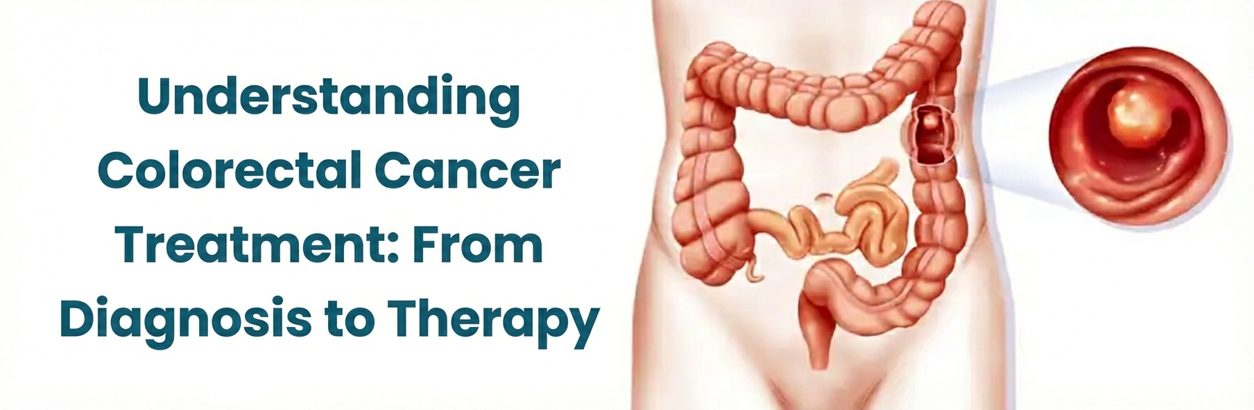 Understanding Colorectal Cancer Treatment: From Diagnosis to Therapy
