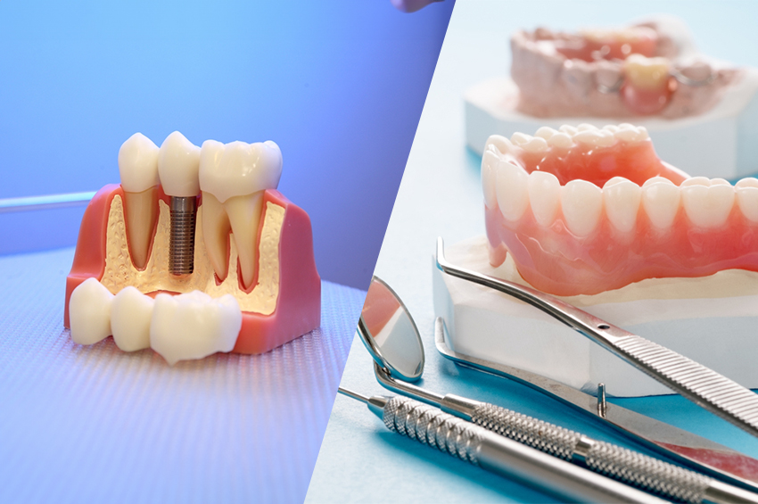 How long do dentures implants last?