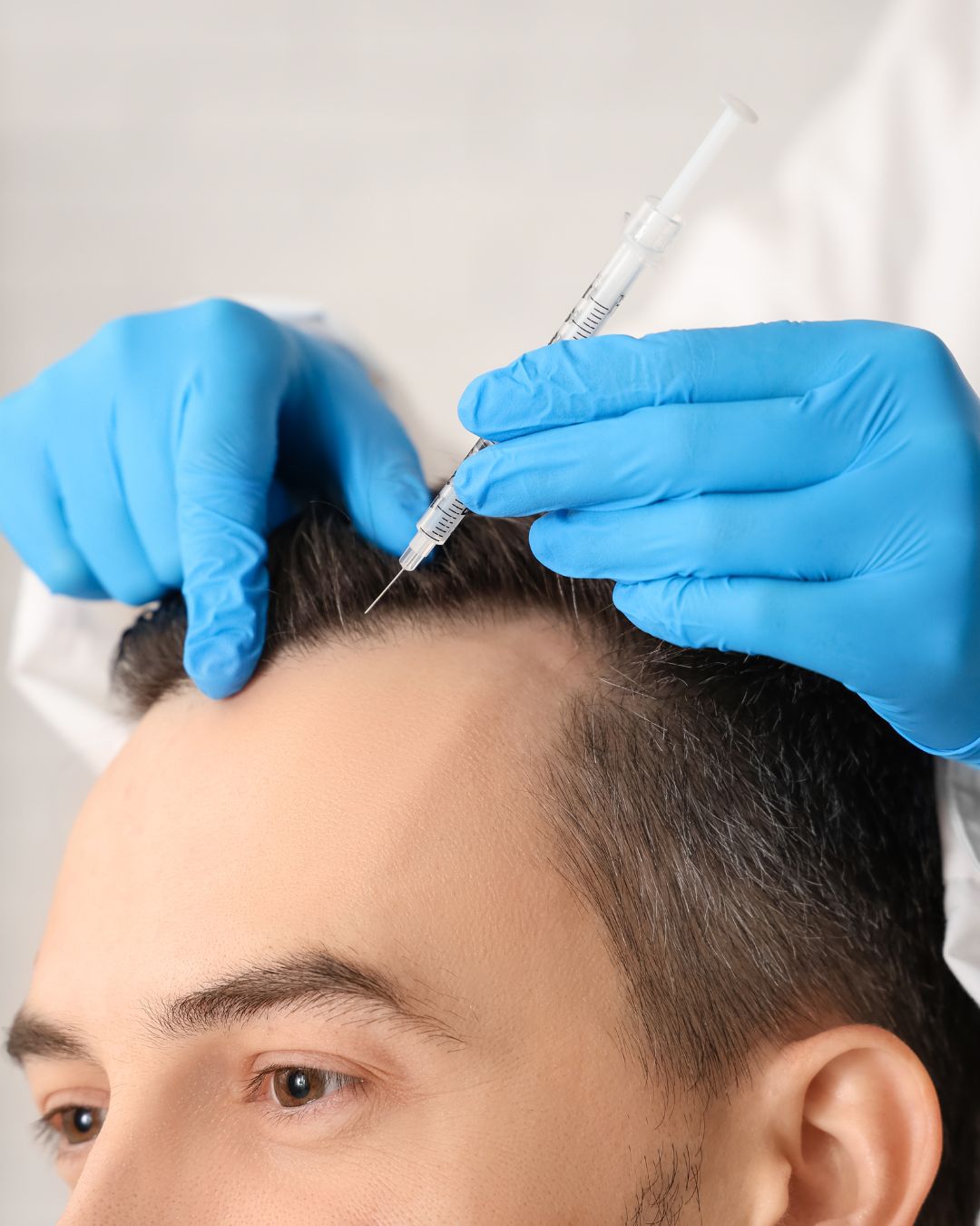 Natural Looking Hair Transplants: What Matters Most