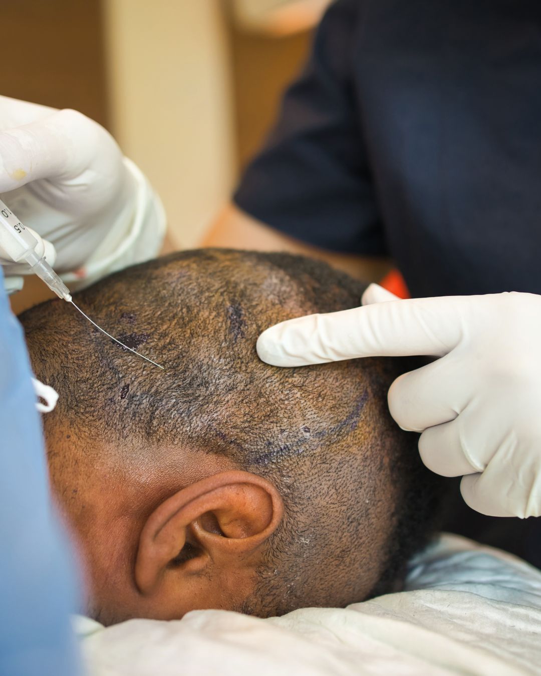 Is Hair Transplant Permanent? Understanding Long-Term Results