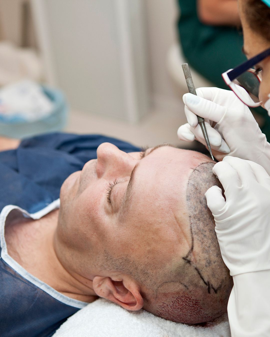 Understanding Hair Transplant Cost and Treatment Value