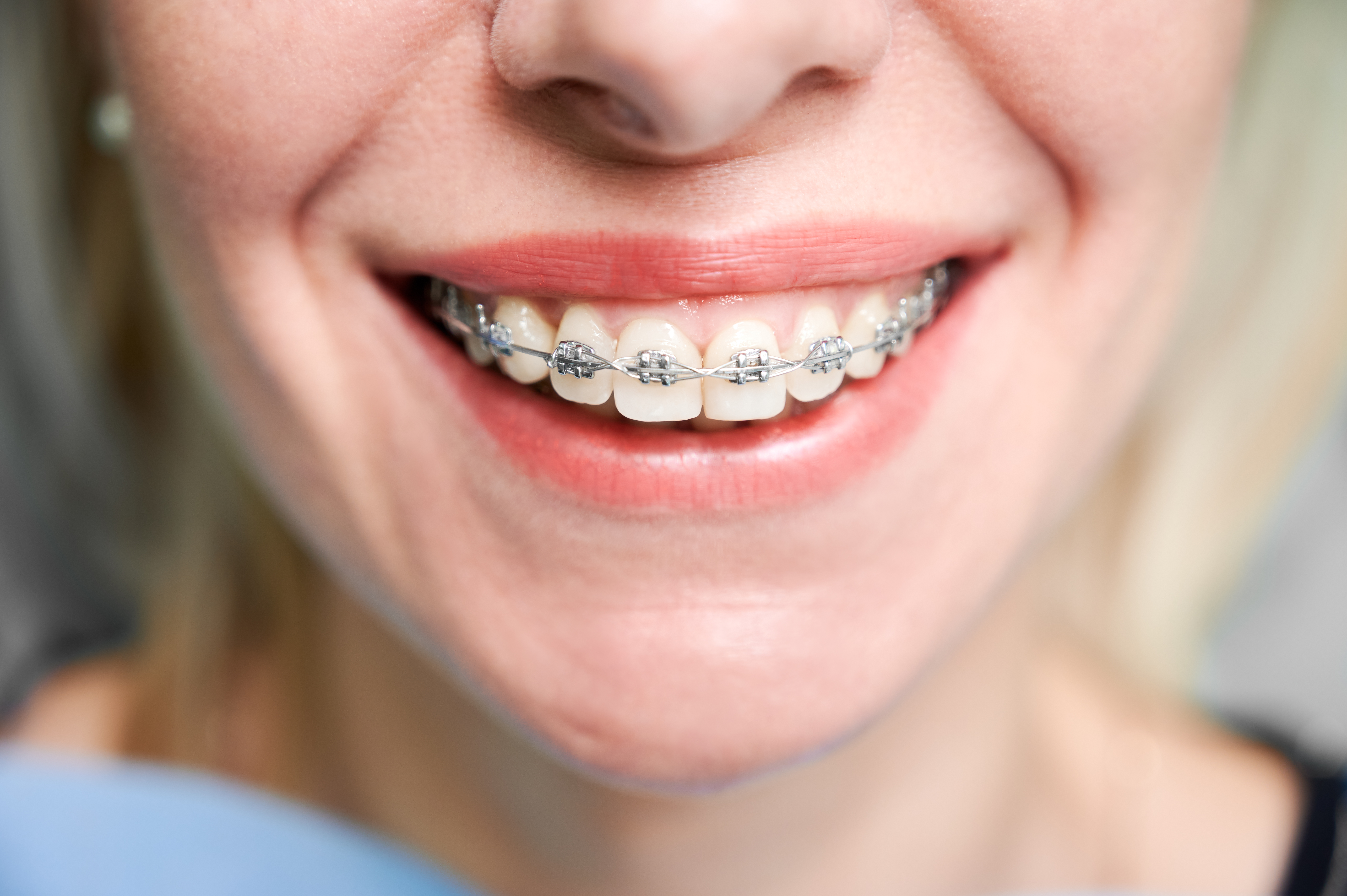 dental braces for straighter smile