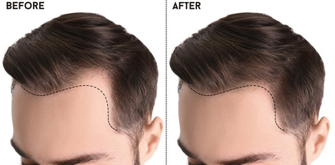 Best Hair Transplant UK: How Expert Surgeons Improve Success Rates