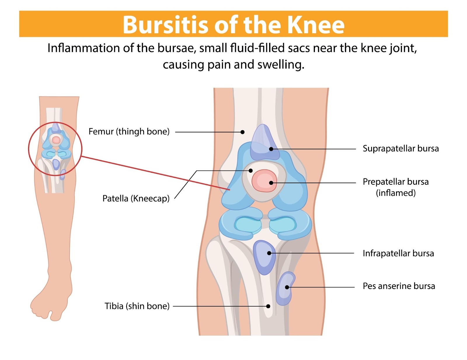 Arthrosamid Injection for Chronic Knee Pain – Does It Work?