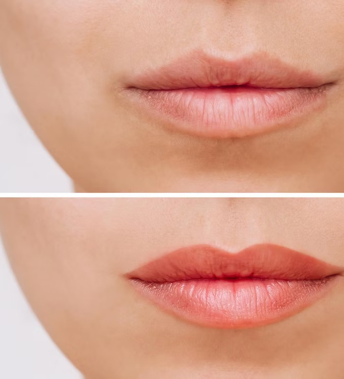 Lip Augmentation in Los Angeles and the Beach Cities around it to get fuller lips that are natural