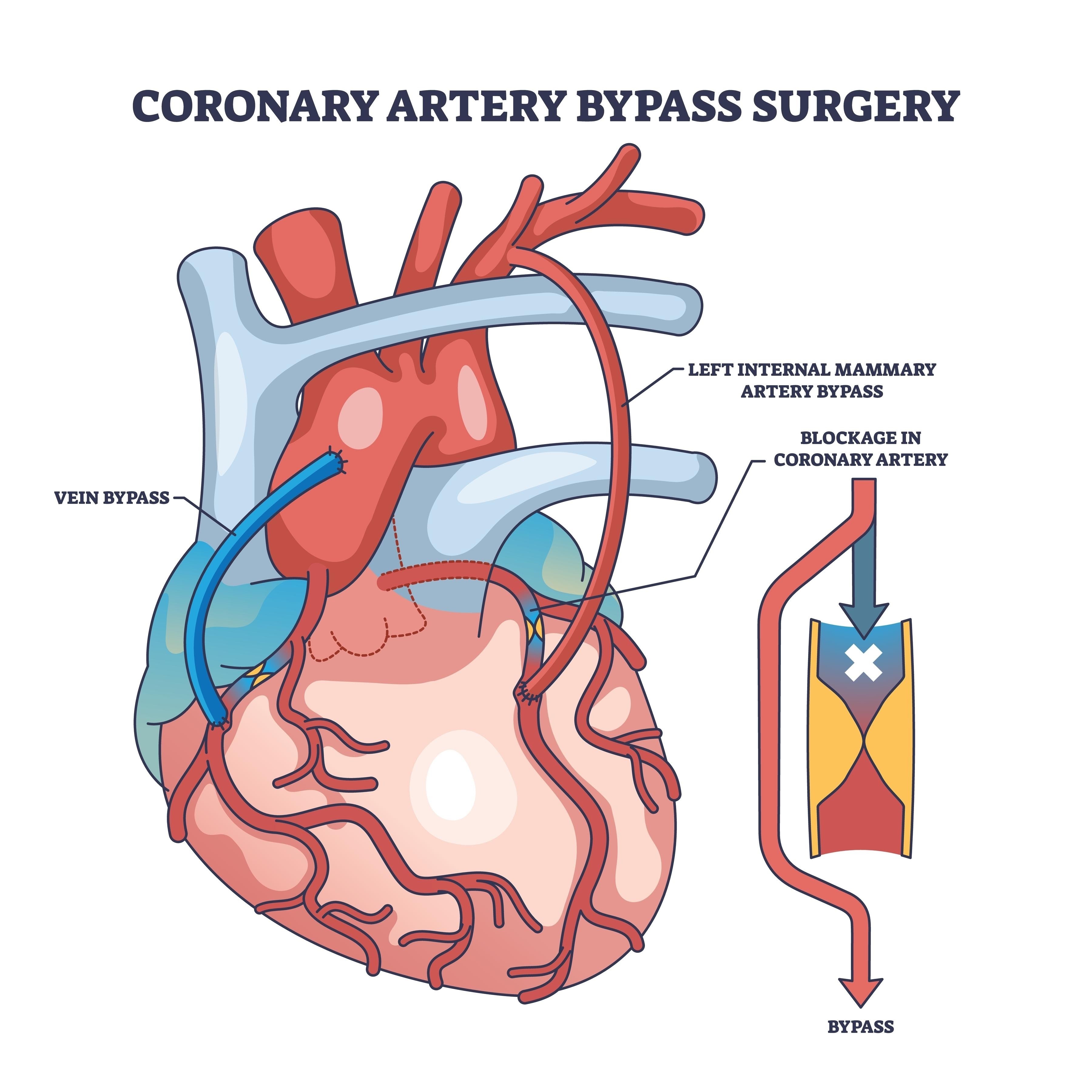 coronary artery bypass graft procedure diagram, AI generated