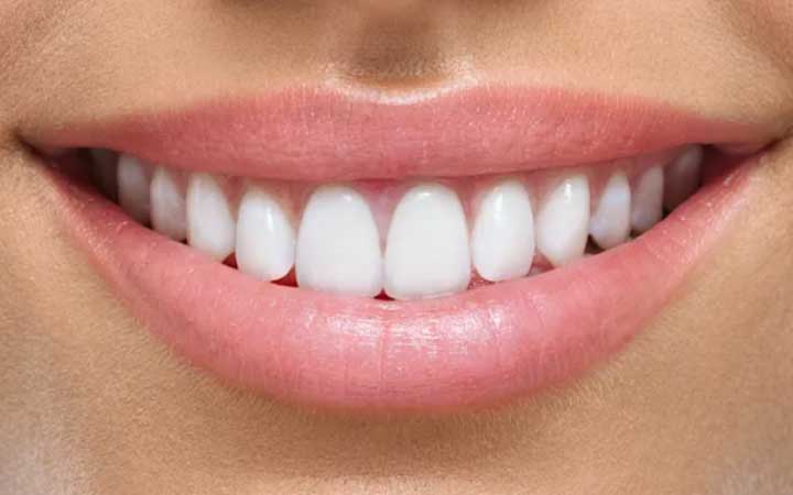 Natural look porcelain veneers